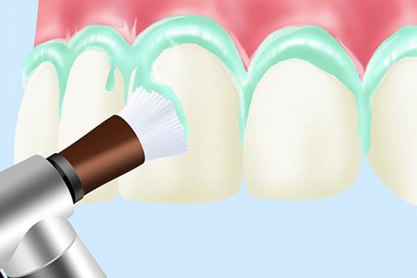 PMTC（Professional Mechanical Tooth Cleaning）